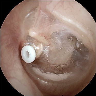 picture of an eardrum with ear tubes